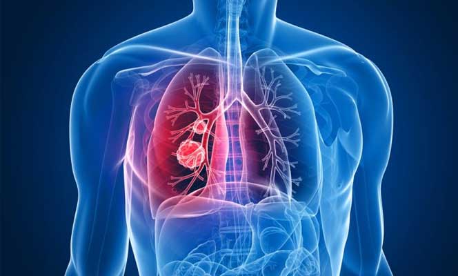 Use of Systemic Steroids in Pulmonary Diseases